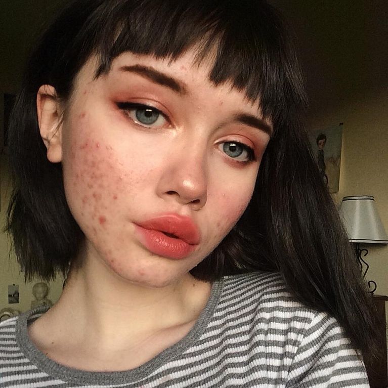 PASTILLAS ANTICONCEPTIVAS PARA EL ACNÉ