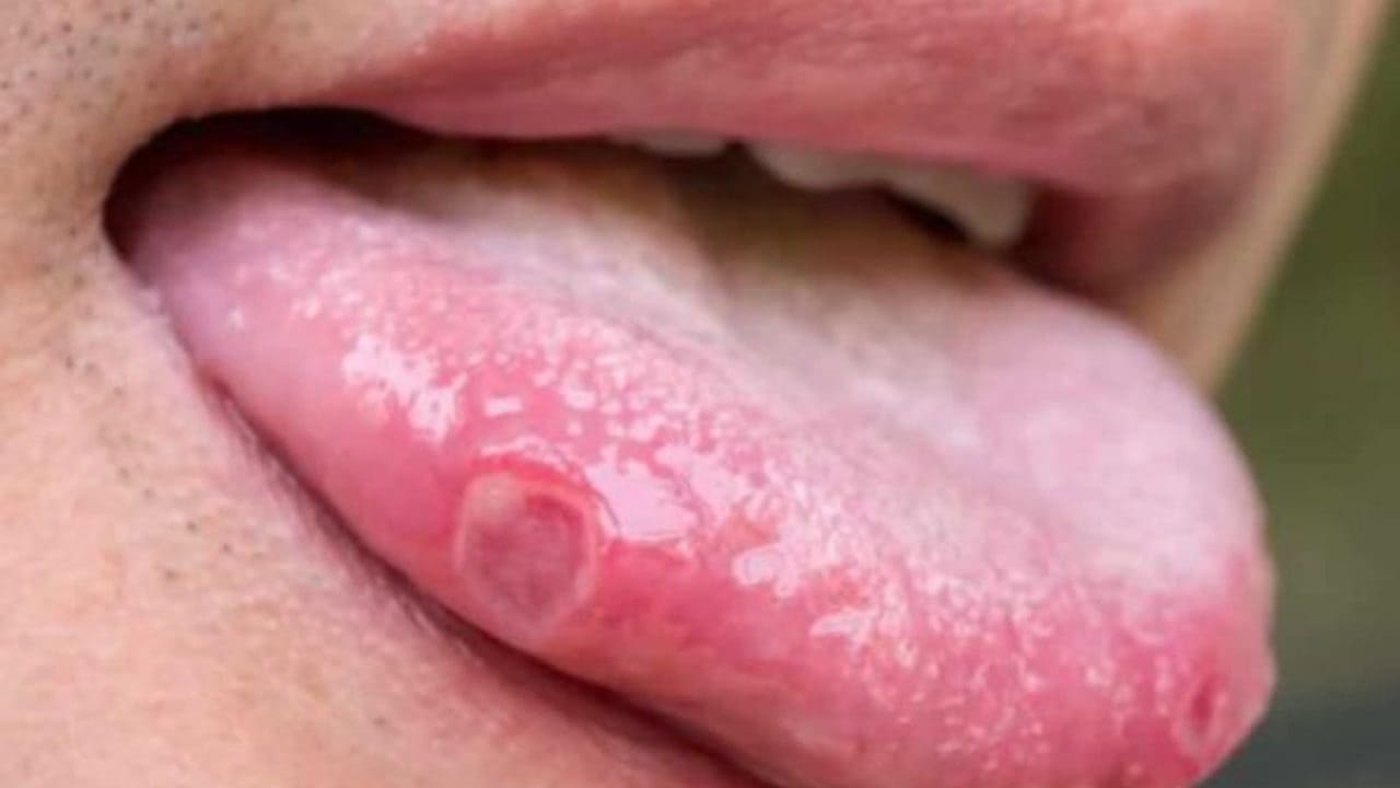 VIRUS DEL PAPILOMA HUMANO 